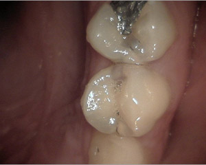 caries1