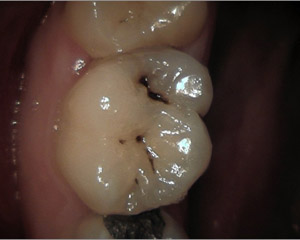 caries2