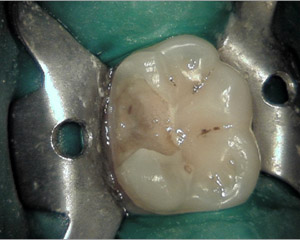 caries4