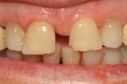 diastema1