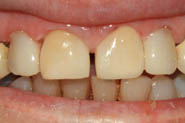 diastema2