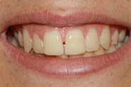diastema3