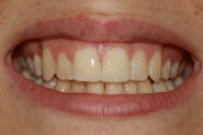 diastema4