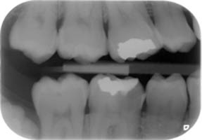 endo1
