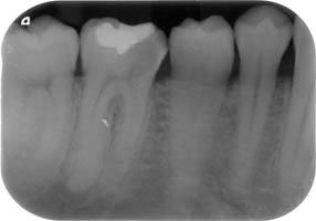 endo2