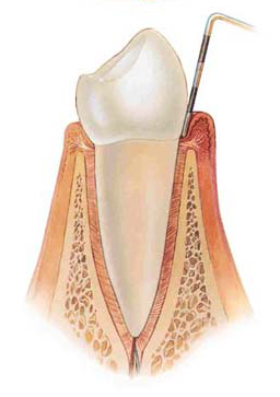 gingivitis