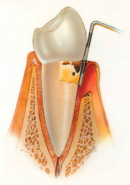 periodontitis severa