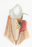 Periodontitis avanzada