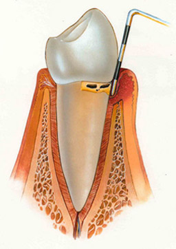 periodontitis incial
